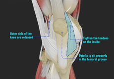 Patellofemoral Knee Replacement